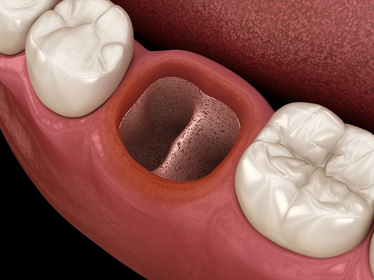 dry socket vs normal hole