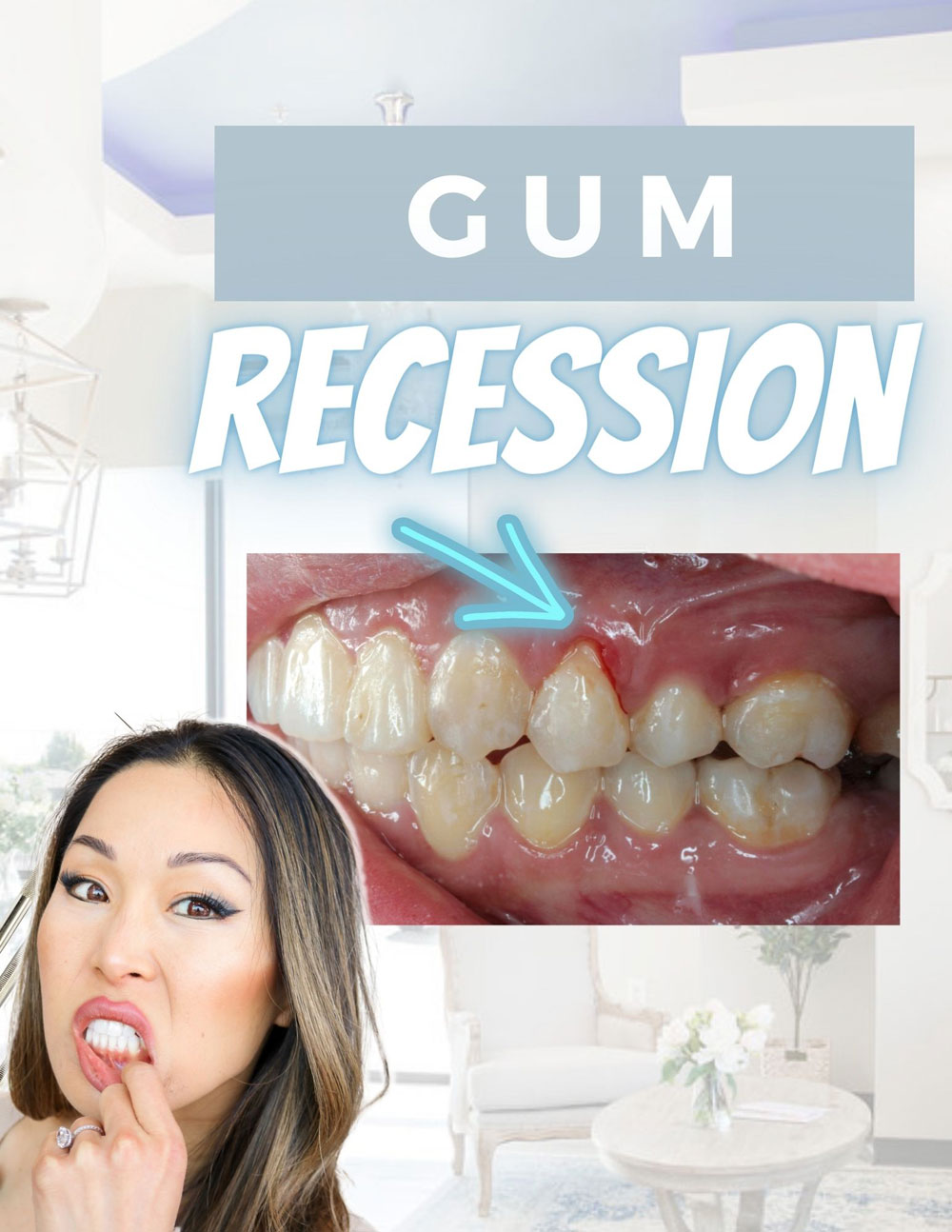 How to Prevent Gum Recession | Thrive Dental and Orthodontics