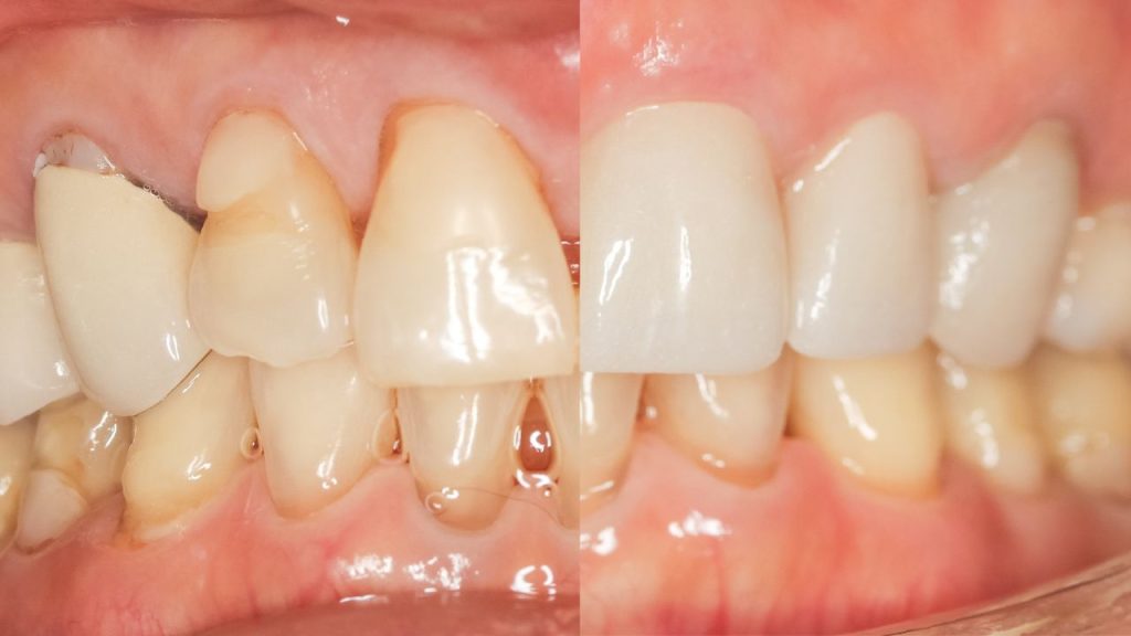 Dental veneers in Dallas before and after